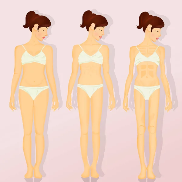 Illustrazione Anoressia Bulimia — Foto Stock