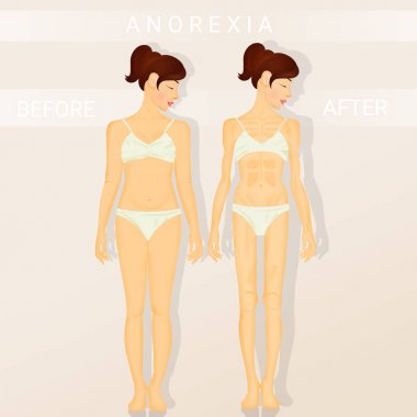 önce ve sonra anoreksiya Illustration