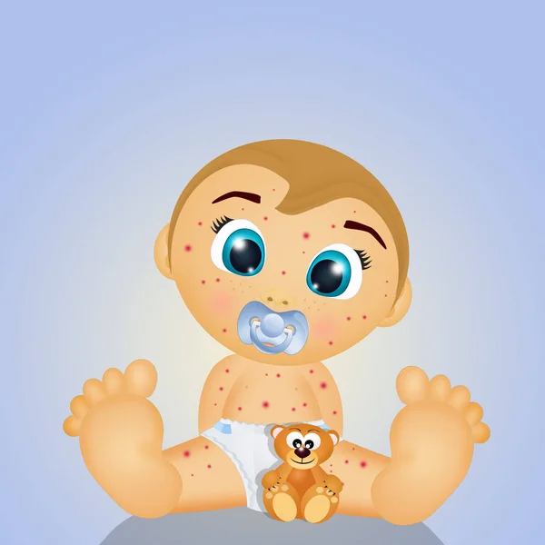 Illustration Baby Chicken Pox — Stock Photo, Image