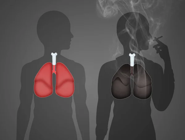 Illustration Smoker Lungs — Stock Photo, Image