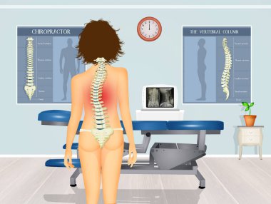 illustration of girl with scoliosis problem clipart