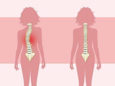 woman with scoliosis problem clipart