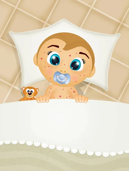 ベッドの上に水痘の赤ちゃんがいて — ストック写真
