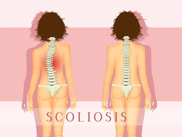 Ilustración Mujer Con Problema Escoliosis —  Fotos de Stock