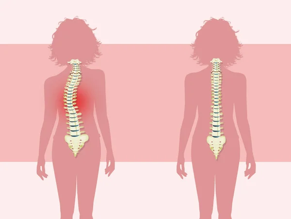 Woman Scoliosis Problem — Stock Photo, Image