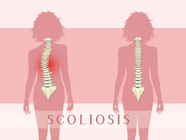 Illustration Scoliosis Problem — Stock Photo, Image