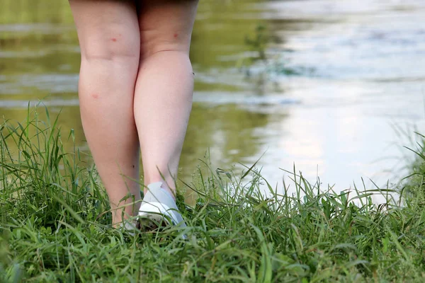 Female Legs Bitten Mosquitoes River Coast Woman Walking Summer Beach — 스톡 사진