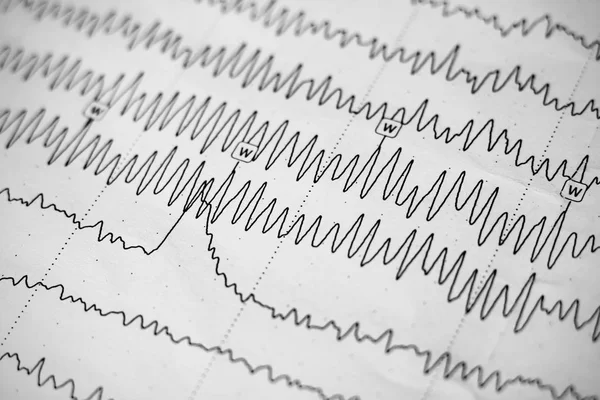 Electroencephalogram resultaat op papier close-up, hersenactiviteit test — Stockfoto