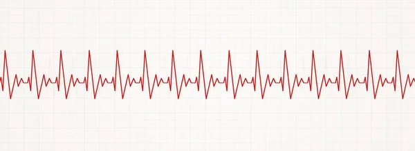 Εικονογράφηση Της Παλλόμενη Ταχεία Ακανόνιστος Καρδιακός Ρυθμός — Φωτογραφία Αρχείου
