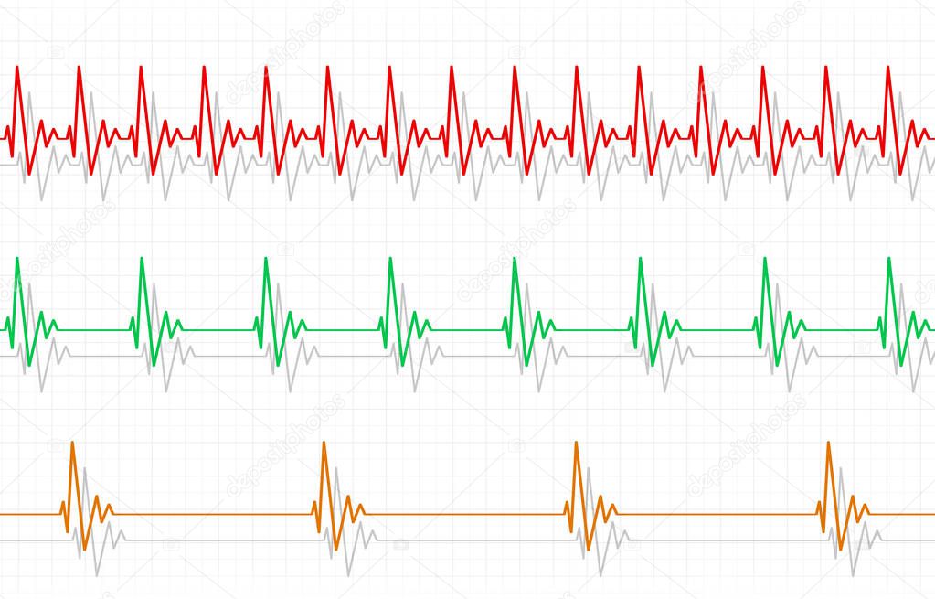 Fast Normal Slow Pulse