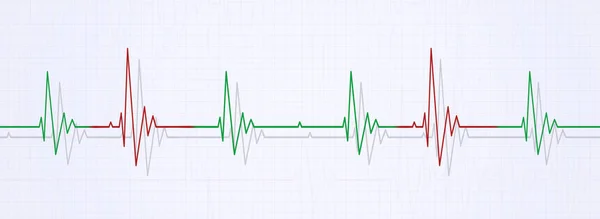 Нерегулярное сердцебиение на ЭКГ — стоковое фото