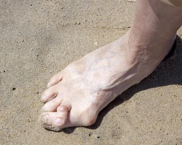 Female foot on a sandy beach with  bunions and hammertoes. Horizontal.