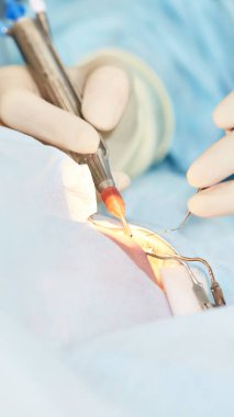 Oftalmoloji lazer mikroskop operasyonu. Klinikte doktor. Hasta göz tedavisi. Miyopi ve katarakt giderme