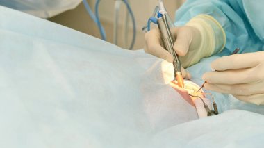 Oftalmoloji lazer mikroskop operasyonu. Klinikte doktor. Hasta göz tedavisi. Miyopi ve katarakt giderme