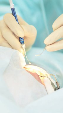 Oftalmoloji lazer mikroskop operasyonu. Klinikte doktor. Hasta göz tedavisi. Miyopi ve katarakt giderme