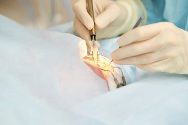 Oftalmoloji lazer mikroskop operasyonu. Klinikte doktor. Hasta göz tedavisi. Miyopi ve katarakt giderme