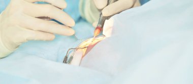 Oftalmoloji lazer mikroskop operasyonu. Klinikte doktor. Hasta göz tedavisi. Miyopi ve katarakt giderme