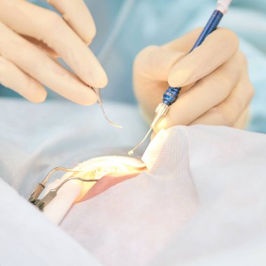 Oftalmoloji lazer mikroskop operasyonu. Klinikte doktor. Hasta göz tedavisi. Miyopi ve katarakt giderme