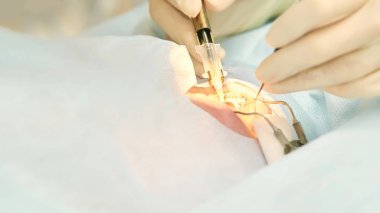 Oftalmoloji lazer mikroskop operasyonu. Klinikte doktor. Hasta göz tedavisi. Miyopi ve katarakt giderme