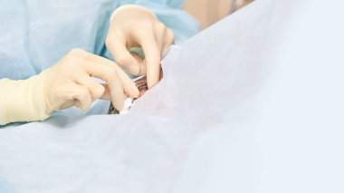 Oftalmoloji lazer mikroskop operasyonu. Klinikte doktor. Hasta göz tedavisi. Miyopi ve katarakt giderme