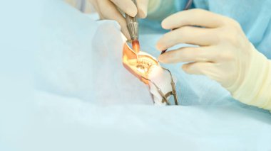 Oftalmoloji lazer mikroskop operasyonu. Klinikte doktor. Hasta göz tedavisi. Miyopi ve katarakt giderme