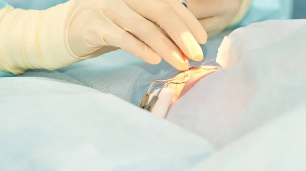 Operación de microscopio láser oftalmológico. Doctor en clínica. Tratamiento ocular del paciente. Miopía y eliminación de cataratas — Foto de Stock