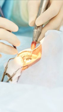 Oftalmoloji lazer mikroskop operasyonu. Klinikte doktor. Hasta göz tedavisi. Miyopi ve katarakt giderme