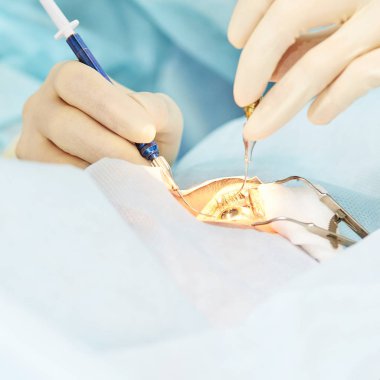 Oftalmoloji lazer mikroskop operasyonu. Klinikte doktor. Hasta göz tedavisi. Miyopi ve katarakt giderme