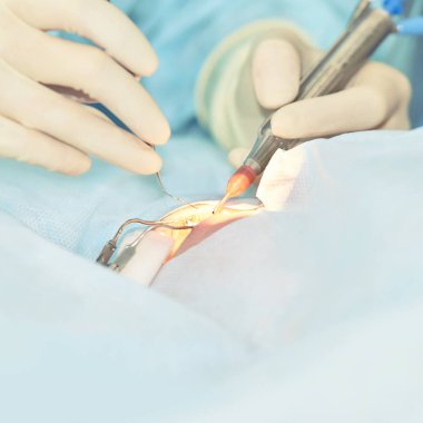 Oftalmoloji lazer mikroskop operasyonu. Klinikte doktor. Hasta göz tedavisi. Miyopi ve katarakt giderme