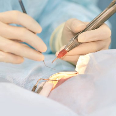 Oftalmoloji lazer mikroskop operasyonu. Klinikte doktor. Hasta göz tedavisi. Miyopi ve katarakt giderme