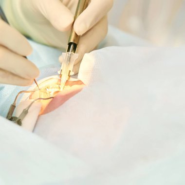 Oftalmoloji lazer mikroskop operasyonu. Klinikte doktor. Hasta göz tedavisi. Miyopi ve katarakt giderme