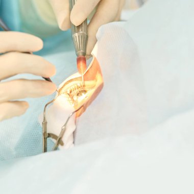Oftalmoloji lazer mikroskop operasyonu. Klinikte doktor. Hasta göz tedavisi. Miyopi ve katarakt giderme
