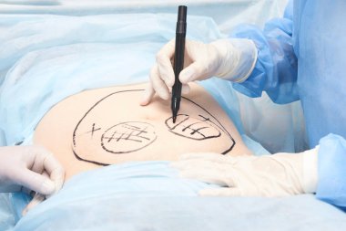 Yağ aldırma operasyonu. Doktor elleri karnına yakın