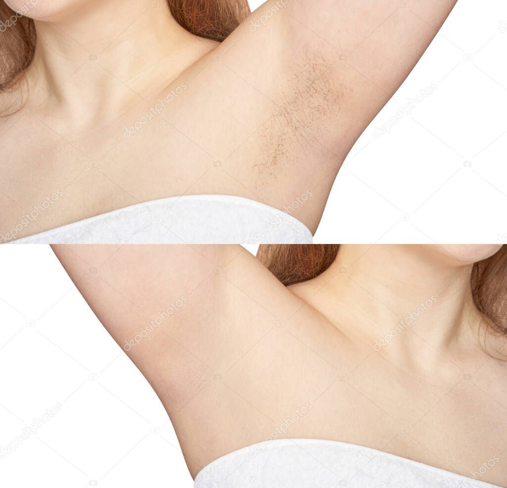 Girl underarm. White woman armpit. Before and after epilation.