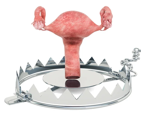 Uterus Disease Concept Human Uterus Bear Trap Rendering Isolated White — Stock Photo, Image