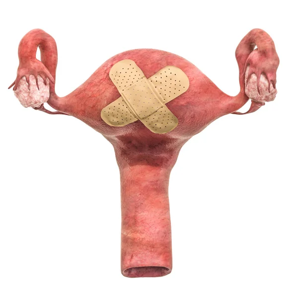 Vrouwelijke Baarmoeder Met Zelfklevende Verbanden Behandeling Van Baarmoeder Concept Rendering — Stockfoto