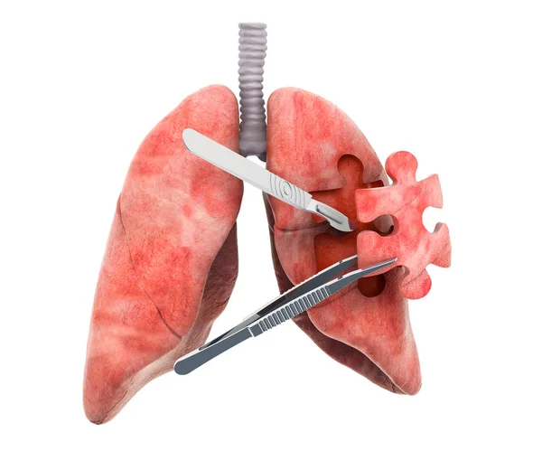 Akciğer Ameliyatı Kavramı Beyaz Arka Plan Üzerinde Izole Render — Stok fotoğraf