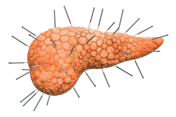 Menschliche Bauchspeicheldrüse Mit Akupunkturnadeln Akupunkturbehandlung Der Bauchspeicheldrüse Darstellung Isoliert Auf — Stockfoto