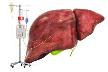 Intravenous therapy system with human liver. Treatment of liver  clipart