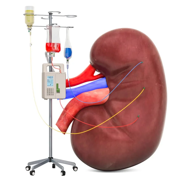 Intraveneuze therapie systeem met menselijke nier. Behandeling van kidne — Stockfoto