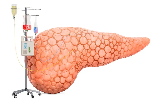 Intravenous therapy system with pancreatic. Treatment of pancrea — Stock Photo, Image