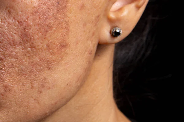 Age Spots Increased Skin Pigmentation Sunburn Rules Health Care Middle — Stock Photo, Image