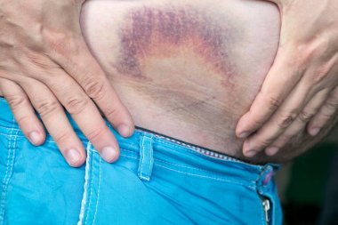 Çürük, insan vücudunda hematom. Büyük bir çürük, yaralanan bir adamın midesinde çürük.