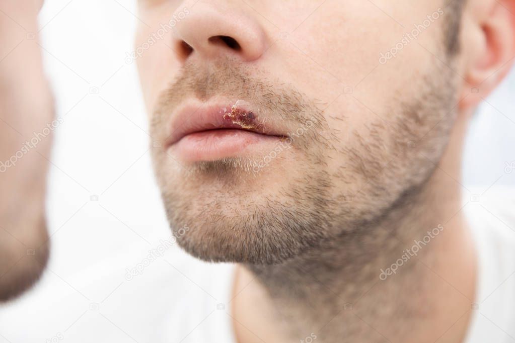 Young man suffering from painful herpes on his mouth