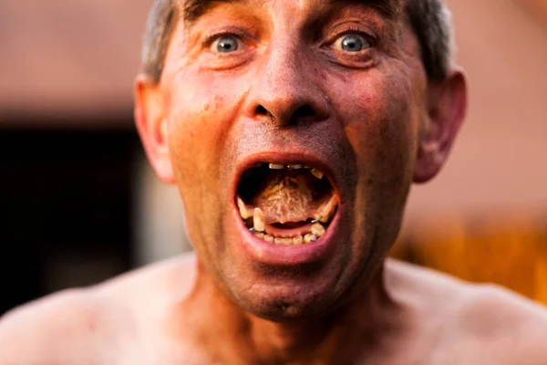 Close up of an old man showing ugly dentures. Tooth decay building up in a wide open mouth. Poor personal hygiene and maintenance. Unhealthy teeth concept.