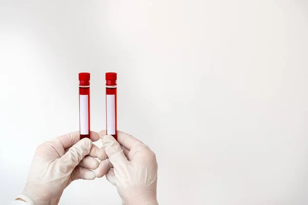 Εργαστηριακός τεχνικός που κατέχει σωλήνα δοκιμής του εκχυλισμένου δείγματος ανθρώπινου αίματος για το διαγνωστικό εργαλείο κινδύνου υγείας. Ιατρική Ανάλυση Έννοια Έρευνας — Φωτογραφία Αρχείου