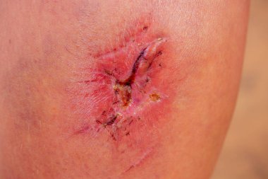 Ameliyat ve dikiş, cilt kusurları veya kusurları nedeniyle siyanotik keloid yara yakın. dermatoloji ve kozmetoloji