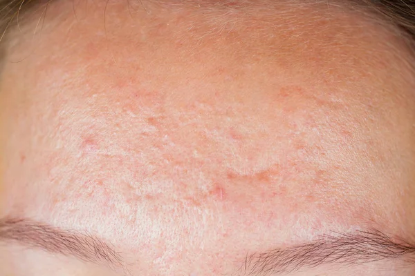 Big acne close-up on the girls face — Stock Photo, Image