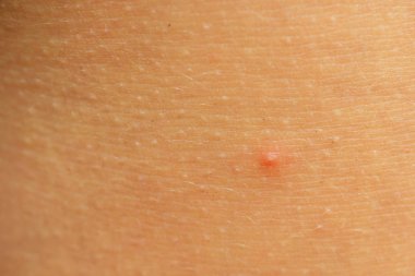 Sivilce sonrası, yara izleri ve yüz derisinde iltihaplı sivilceler. Cilt sorunları ve harmonik arıza kavramı