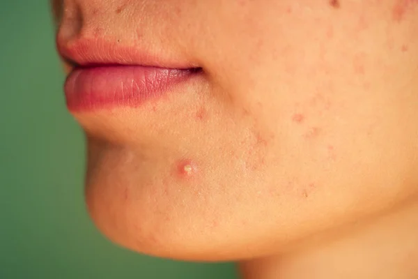 Acné, cicatrices y granos rojos supurantes en la cara de una mujer joven. concepto de problemas de la piel y fallo armónico —  Fotos de Stock